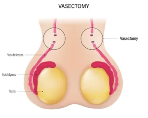 vasectomia-Siena