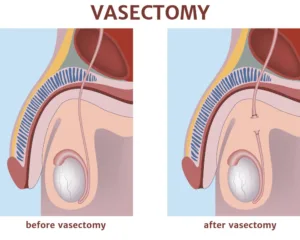 vasectomia-Firenze